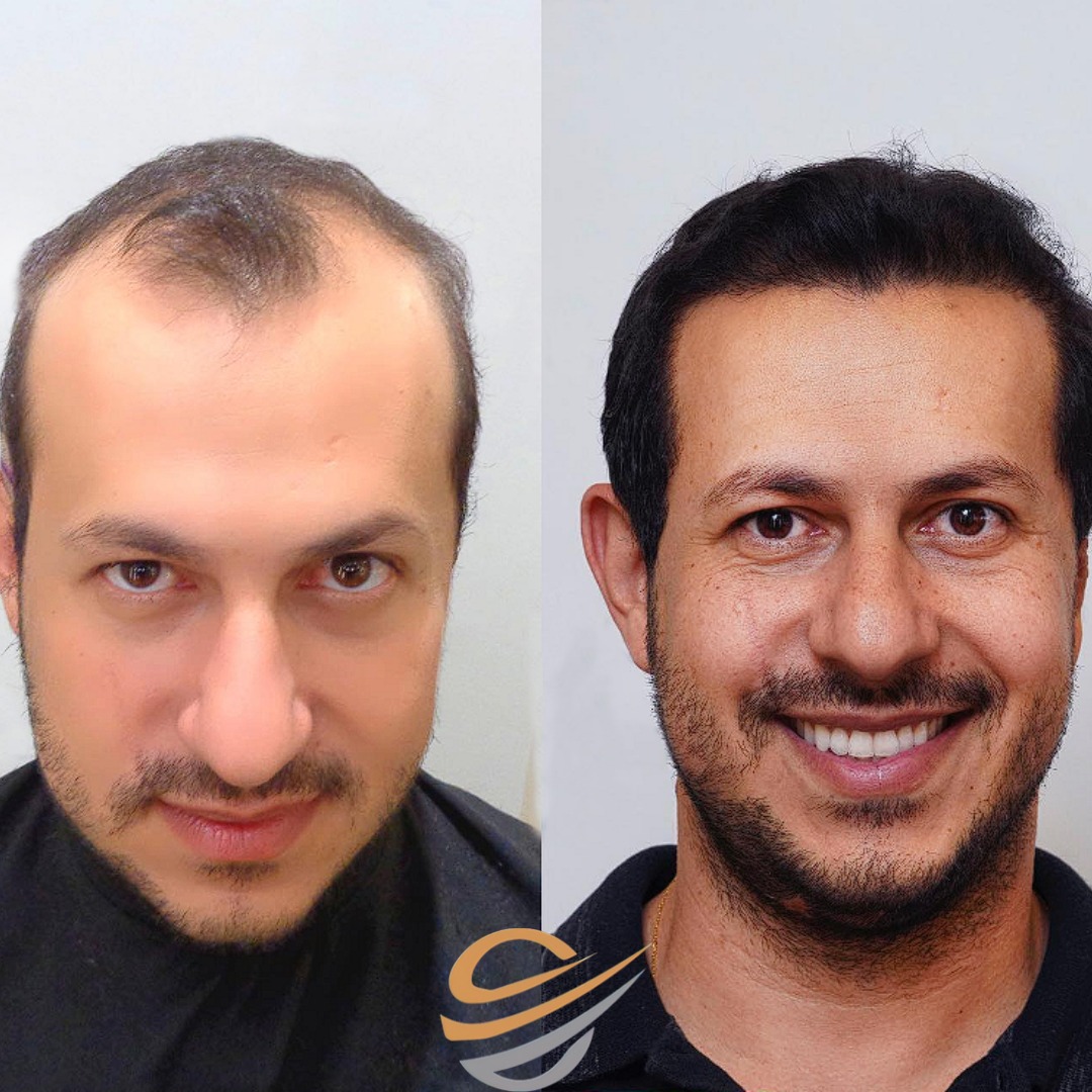 before after hairtransplant