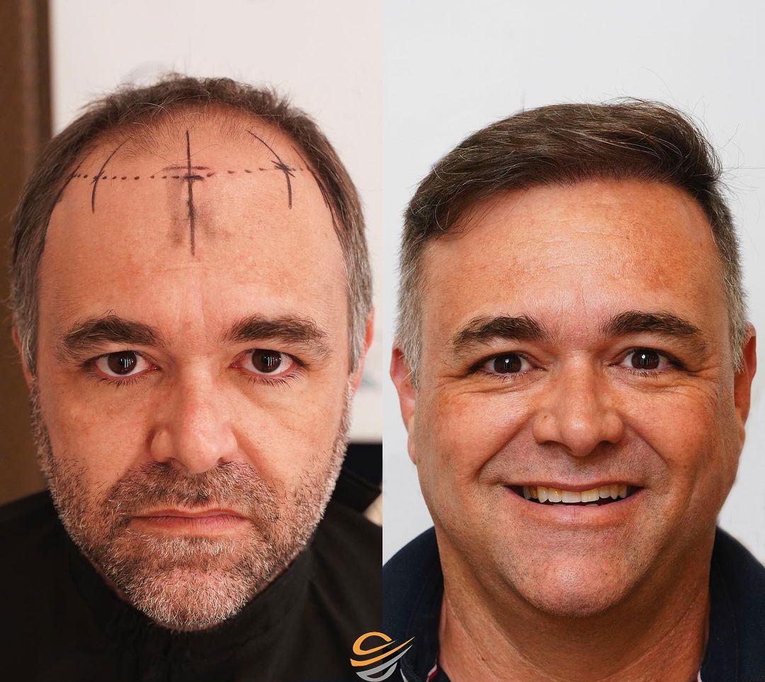 before after hairtransplant