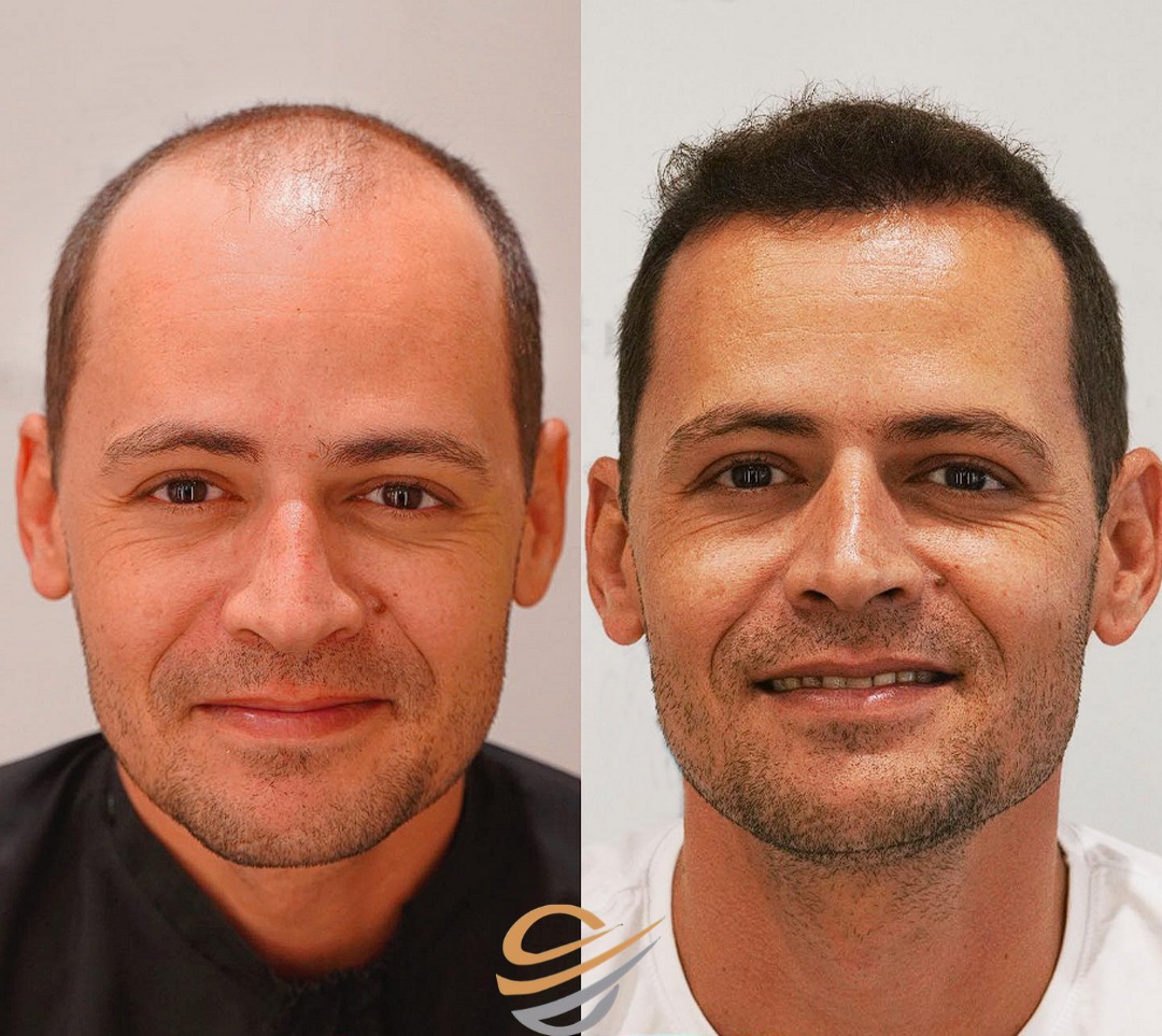before after hairtransplant