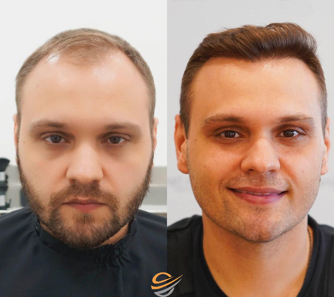 before after hairtransplant