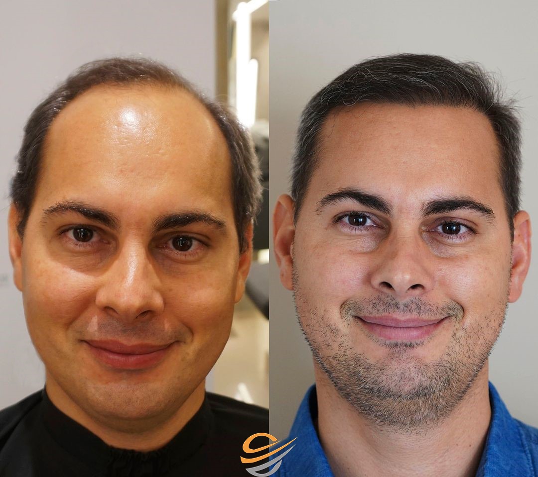 before after hairtransplant