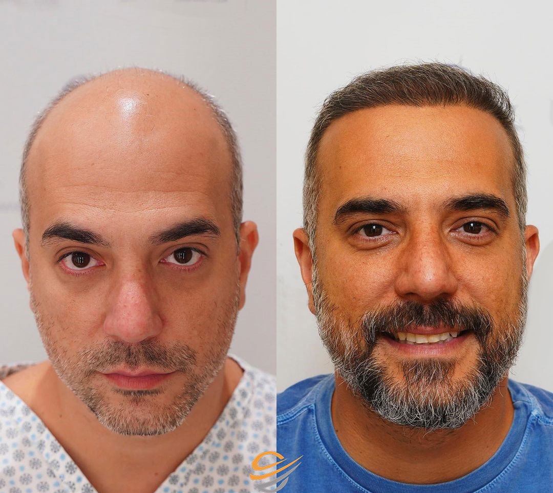 before after hairtransplant