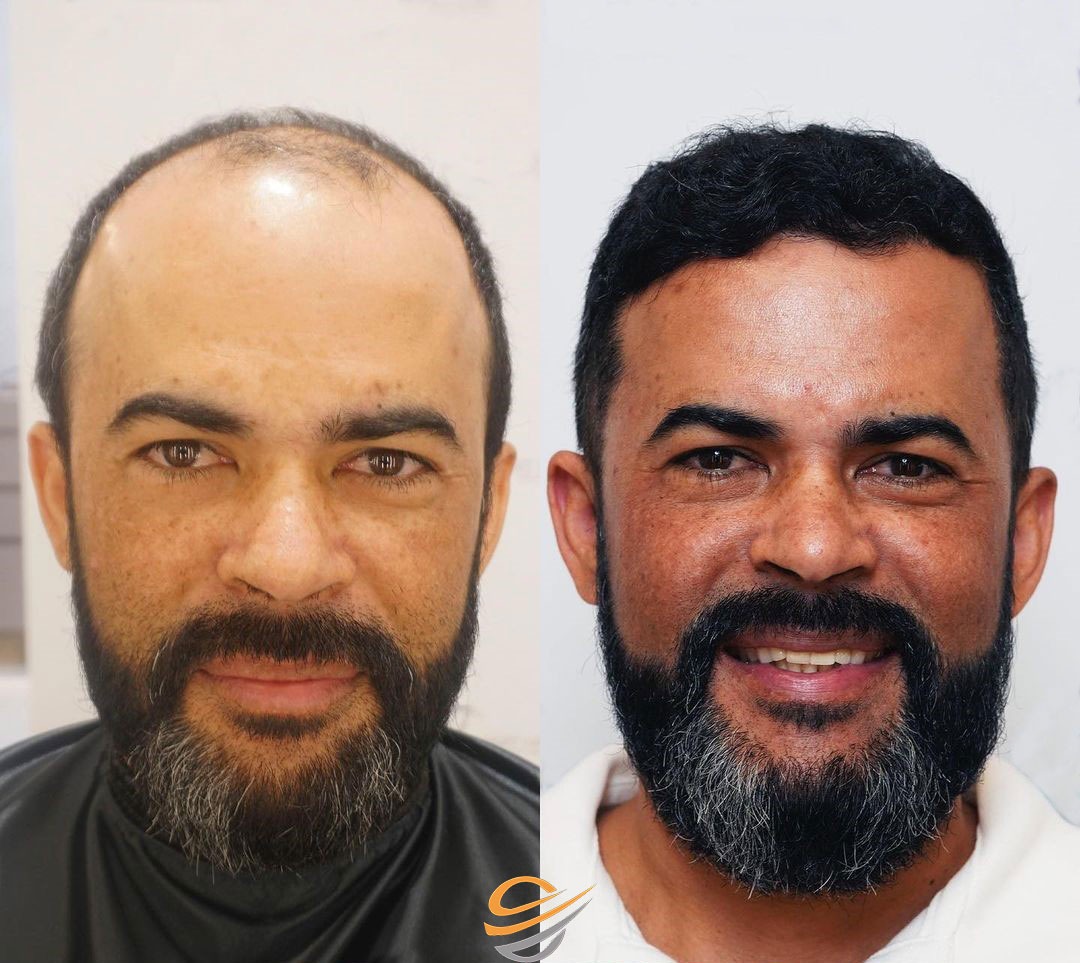 before after hairtransplant