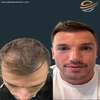 patient hair transplant